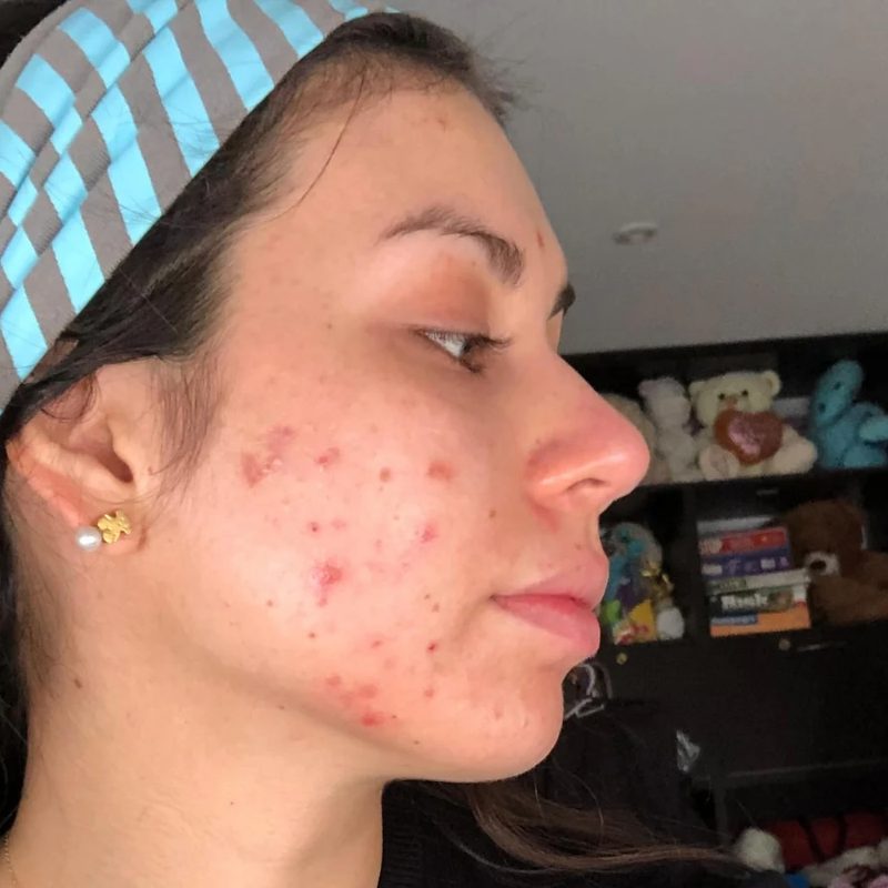 Antes del método: piel con acné hormonal